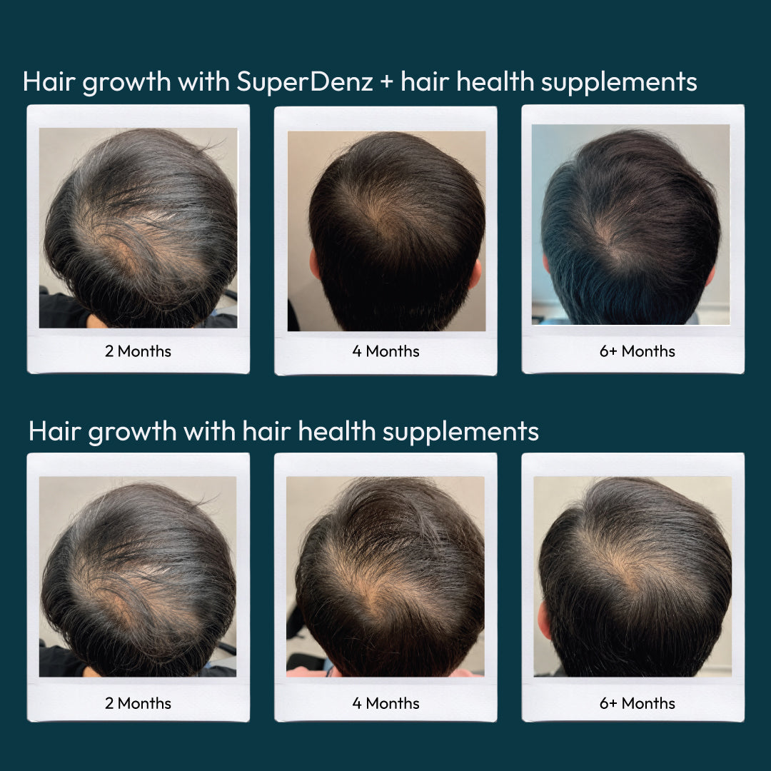 5% Minoxidil & 0.1% Finasteride Solution