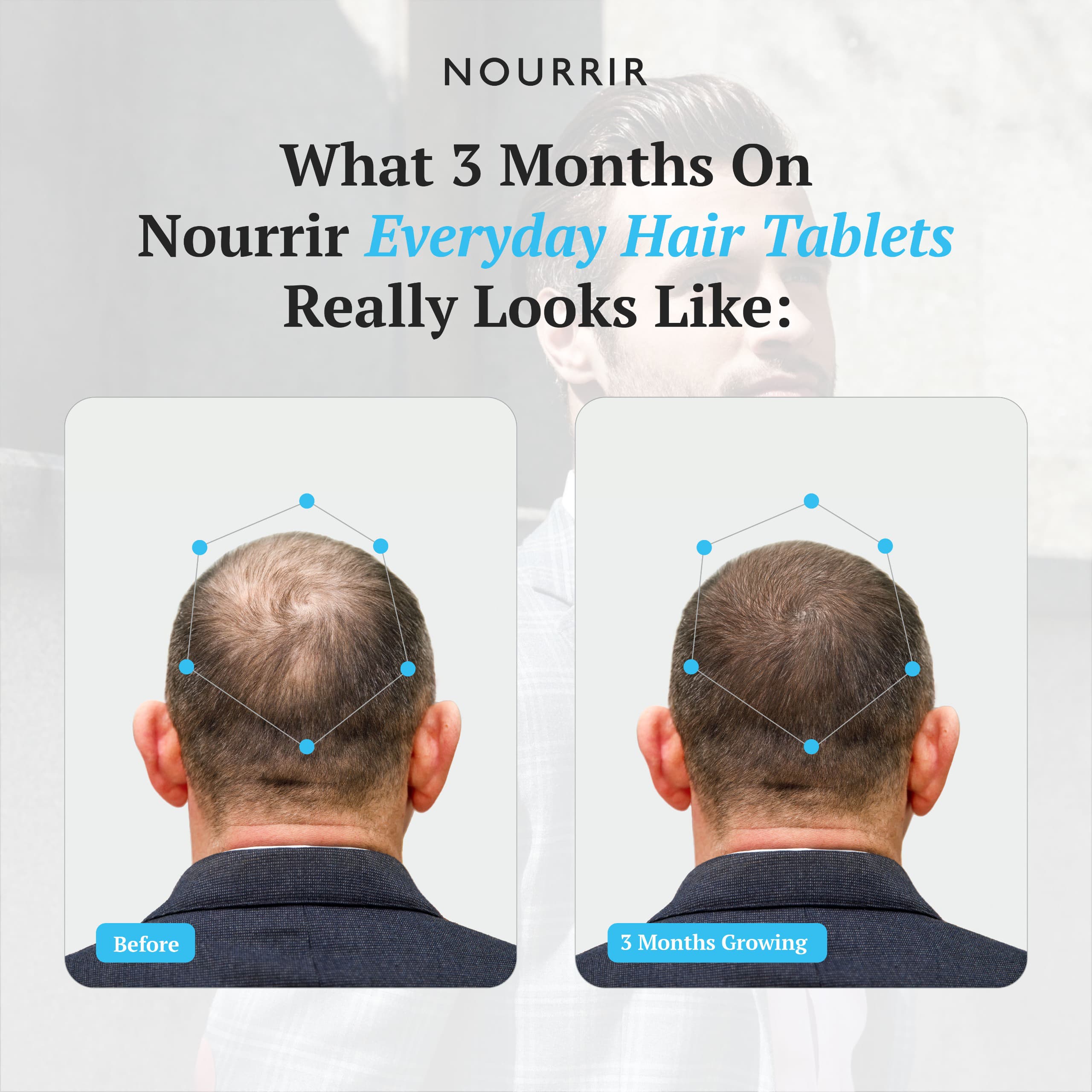 Everyday Hair Health Tablets (Male) - For Hair Growth &amp; Hairfall Reduction