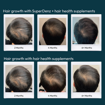 5% Minoxidil &amp; 0.1% Finasteride Solution